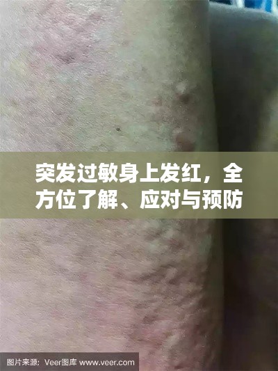 突发过敏身上发红，全方位了解、应对与预防策略