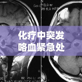 化疗中突发咯血紧急处理与关注要点