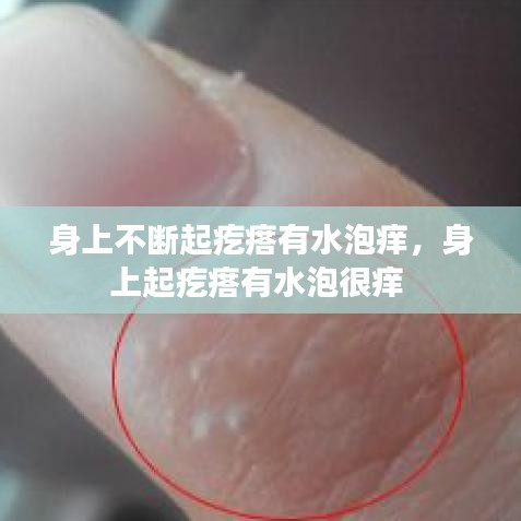 身上不断起疙瘩有水泡痒，身上起疙瘩有水泡很痒 