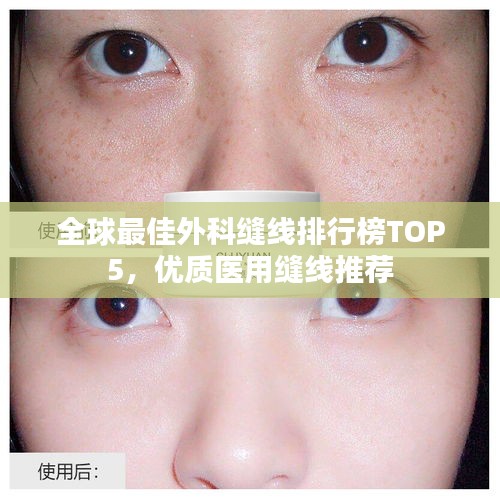 全球最佳外科缝线排行榜TOP5，优质医用缝线推荐