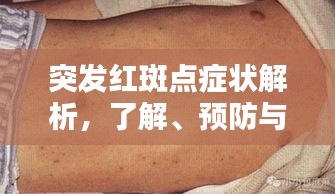 突发红斑点症状解析，了解、预防与治疗策略